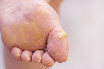 Preventing and Treating Calluses and Corns — Advanced Feet & Ankle Care