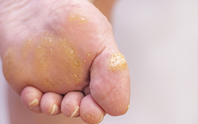 Corns vs Calluses