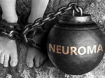 What is a Neuroma?