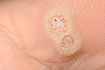 What are Plantar Warts?
