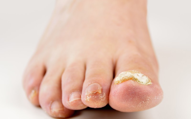 Do you have Thick, Discoloured Toenails?