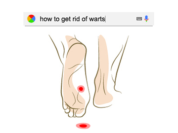 What is Autoimmune Therapy (also known as Needling Warts)?