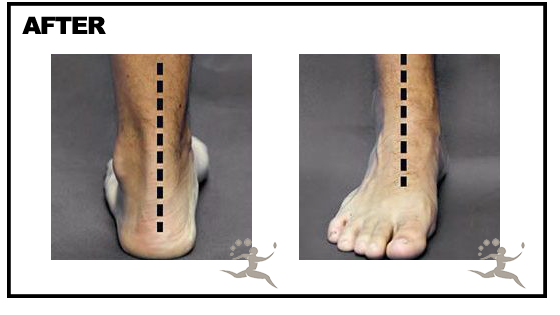 Realigned Feet After HyProCure® Procedure