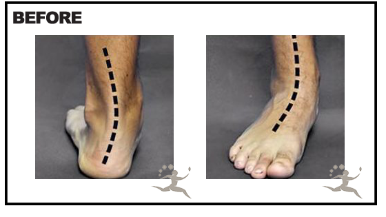 Misaligned Feet Before HyProCure® Procedure