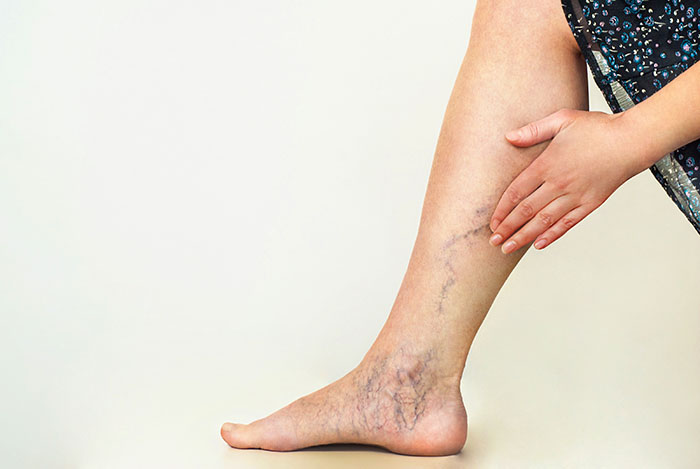 Your Guide To The Best Compression Stockings For Varicose Veins