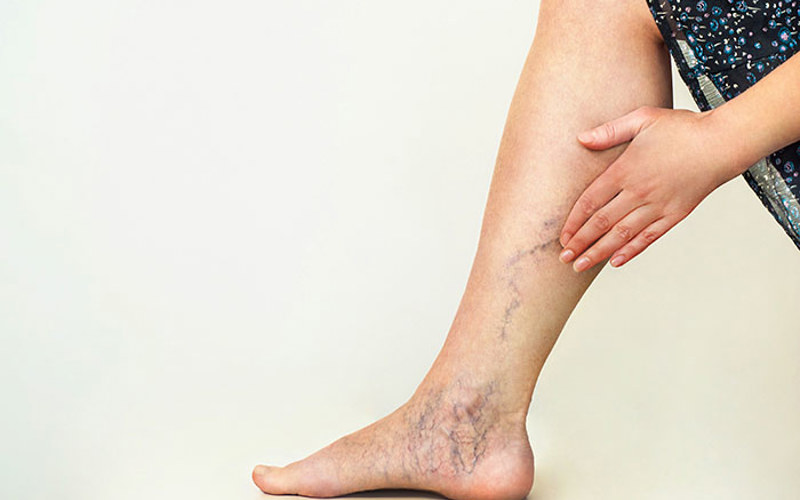 Varicose Veins and Compression Socks