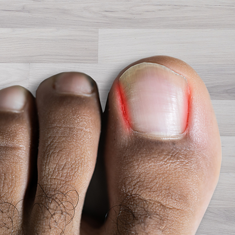 About Ingrown Toenail Surgery