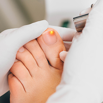 Ingrown Toenail Removal Treatment - Toronto Laser Nail