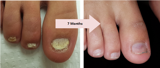 Nail Fungus Genesis Light Treatment